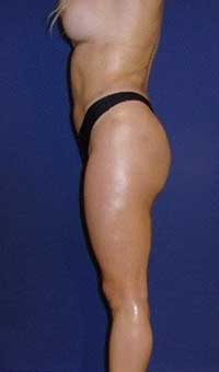 buttock augmentation